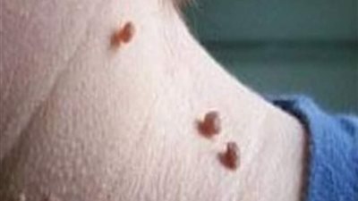 كيف يمكن علاج الزوائد الجلدية؟
