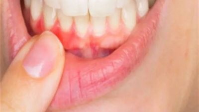 علاج التهاب اللثة