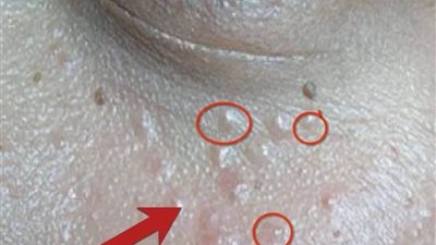 علاج حبوب حول العين بوصفات منزلية