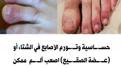 تورم أصابع القدمين في الشتاء أسبابة وهل له مضاعفات؟ وكيف تتجنبه؟