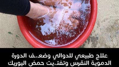 علاج الدوالي بشكل نهائ