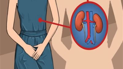 علاج حصى الكلى طبيعيًا