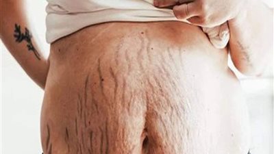علاج السيلوليت: أفضل الطرق الطبية والطبيعية