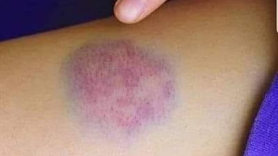 كدمات الجسم علاجها وأسباب ظهورها بالفيديو لن تشتكي منها بعد اليوم