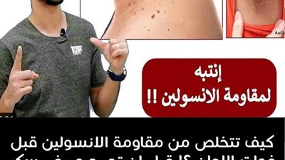 سواد الرقبة ومقاومة الأنسولين هل بينهم علاقة؟