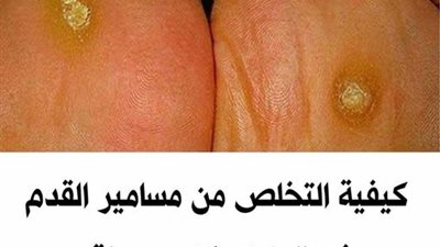 علاج مسمار القدم ١٣ وصفة مفعولها سريع بدون أثار جانبية