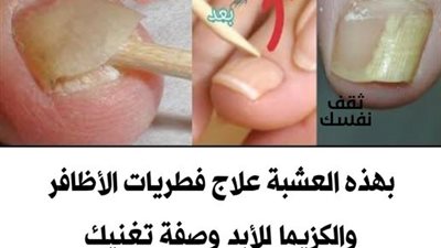علاج فطريات الأظافر بالزيوت الأساسية