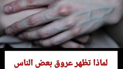 لماذا تظهر عروق بعض الناس من الجلد وتختفي عن آخرين