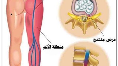 اسباب عرق النسا أشهر ٨ أشياء تجعلك تُصاب به