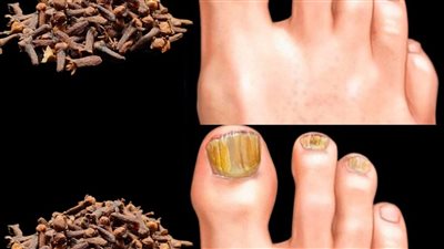 علاج فطريات القدم خلال ساعة فقط