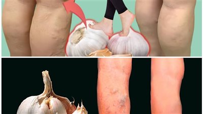 علاج الدوالي بمرهم الثوم و الليمون من صنع يدك