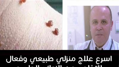 علاج الزوائد الجلدية وصفات تخلصك منها بشكل طبيعي وأمن