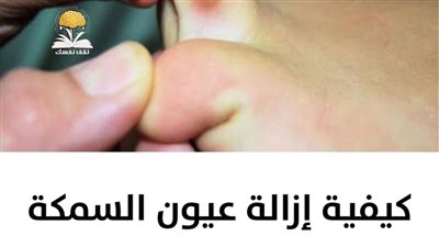 علاج عين السمكة فيديو يشرح أفضل طرق العلاج الطبيعية
