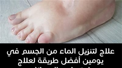 ٧ طرق لعلاج احتباس الماء بالجسم التي تُسبب زيادة الوزن