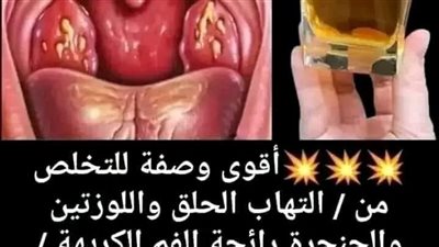 التهاب سقف الحلق أسبابه وعلاجه طبيعيا