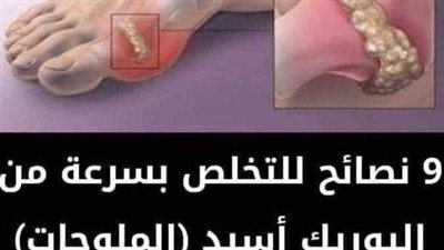 وصفات علاج النقرس بأبسط المكونات