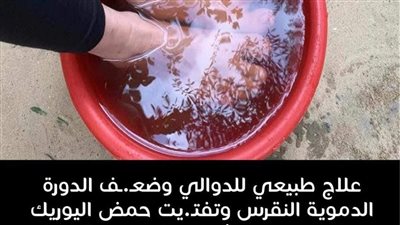 علاج الدوالي بشكل نهائي
