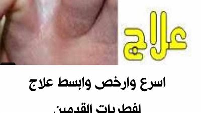 ٧ طرق فعالة في علاج فطريات القدم