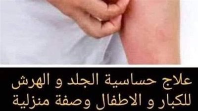 9 علاجات منزلية لحساسية الأرتيكاريا