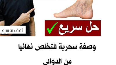 كيف تعالج دوالي الساقين .. الأسباب والعلاج