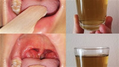 التهاب سقف الحلق أسبابه وعلاجه طبيعيا