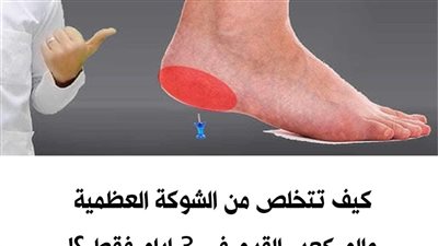 علاج الشوكة العظمية بـ ٦ وصفات من الطبيعة بدون أدوية