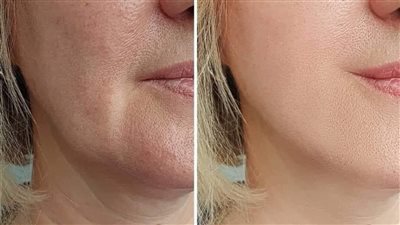 10ماسكات للبشرة العادية للتفتيح بشكل طبيعي وأمن