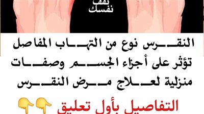 علاج النقرس بالأعشاب دليل شامل لتخفيف الألم والالتهاب