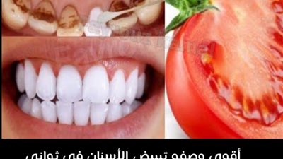 تبييض الأسنان لجعلها چذابه جدا 