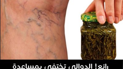 علاج الدوالي بمرهم الثوم و الليمون من صنع يدك
