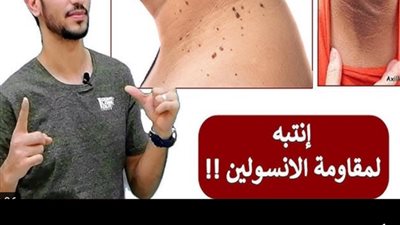 سواد الرقبة ومقاومة الأنسولين هل بينهم علاقة؟