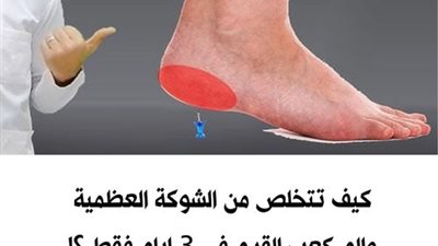 علاج الشوكة العظمية بـ ٦ وصفات من الطبيعة بدون أدوية