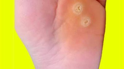 طرق لعلاج عين السمكة في الرجل
