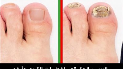 ٧ طرق فعالة في علاج فطريات القدم