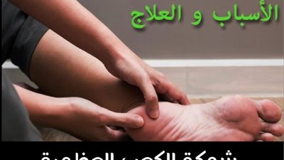 الشوكة العظمية في الكعب أسبابها وأعراضها وطرق علاجها والوقاية منها